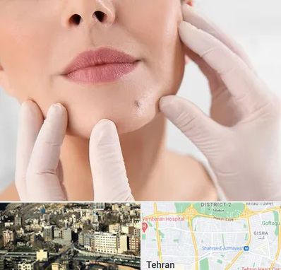 برداشتن خال در مرزداران 