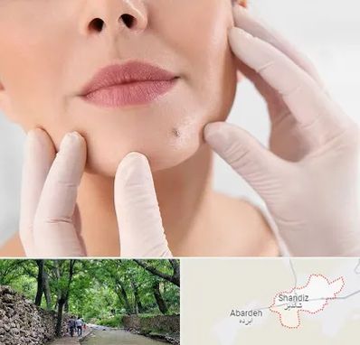 برداشتن خال در شاندیز مشهد