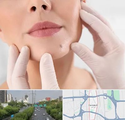 برداشتن خال در توانیر