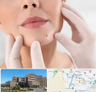 برداشتن خال در صیاد شیرازی مشهد