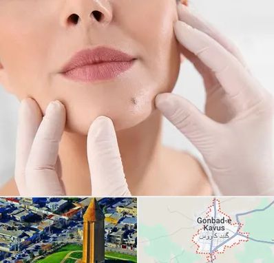 برداشتن خال در گنبد کاووس
