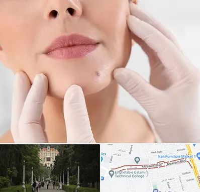 برداشتن خال در بلوار معلم رشت 