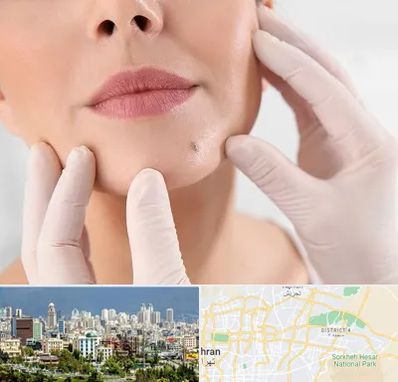 برداشتن خال در شرق تهران 