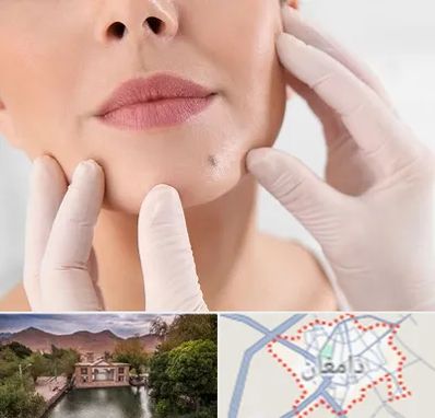 برداشتن خال در دامغان