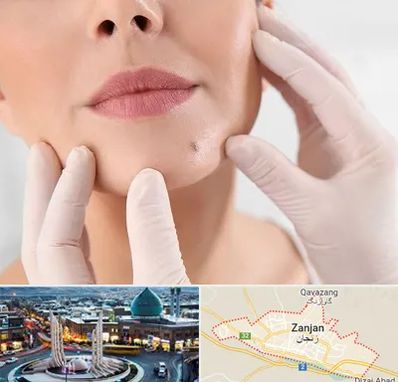 برداشتن خال در زنجان