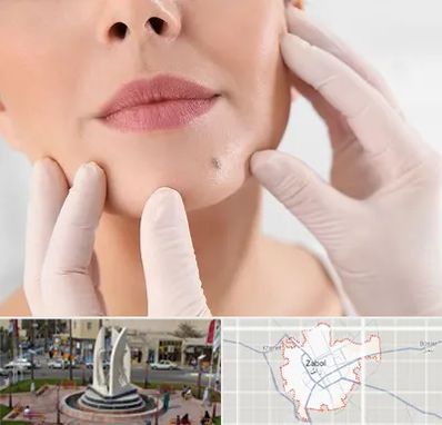 برداشتن خال در زابل