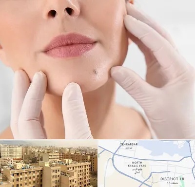برداشتن خال در جنوب غرب تهران
