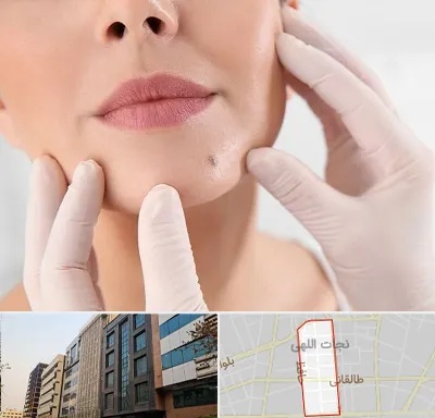 برداشتن خال در نجات اللهی