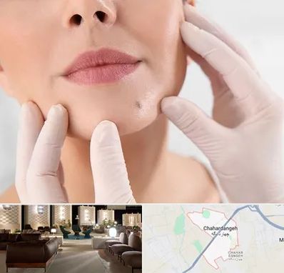 برداشتن خال در چهاردانگه