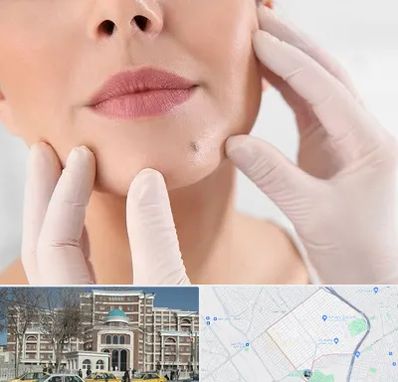 برداشتن خال در طلاب مشهد