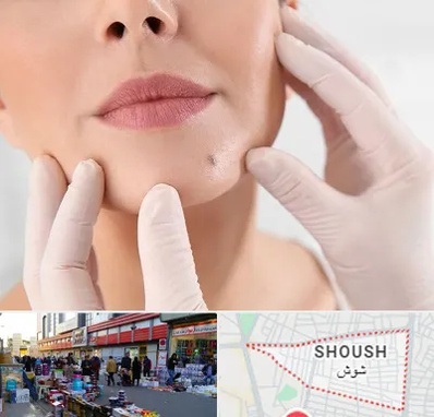 برداشتن خال در شوش