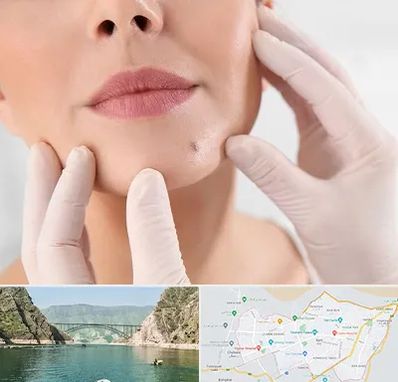 برداشتن خال در ایلام