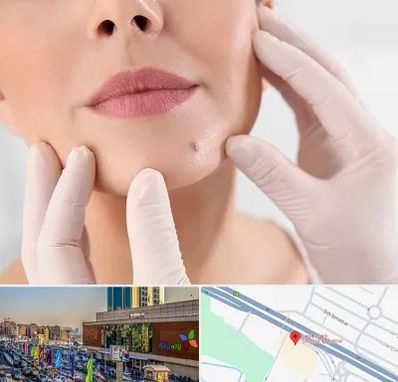 برداشتن خال در لاله پارک تبریز