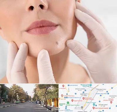 برداشتن خال در شریعتی 