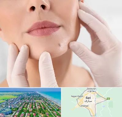 برداشتن خال در ساری