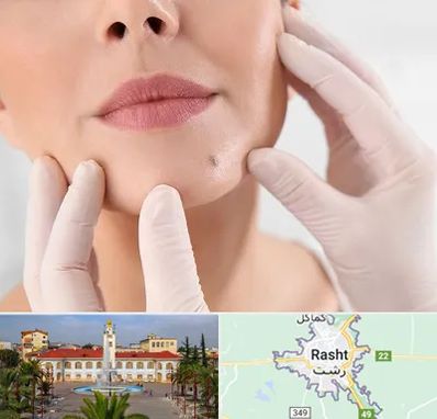 برداشتن خال در رشت