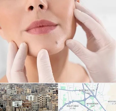 برداشتن خال در جنوب شرق تهران
