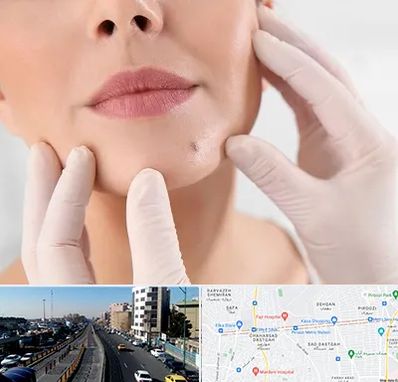 برداشتن خال در پیروزی 