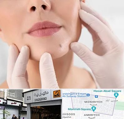 برداشتن خال در منیریه 