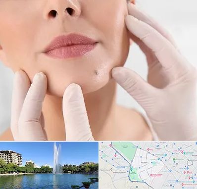 برداشتن خال در کوهسنگی مشهد