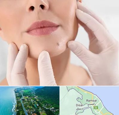 برداشتن خال در رامسر