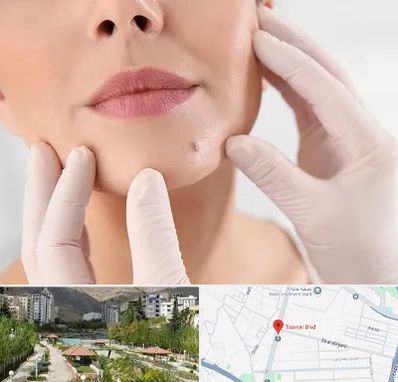 برداشتن خال در بلوار تعاون