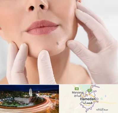 برداشتن خال در همدان