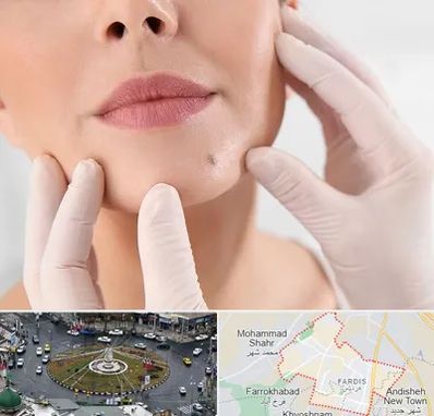 برداشتن خال در فردیس کرج 