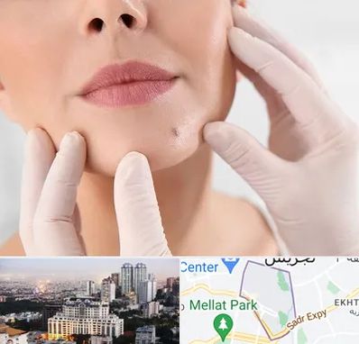 برداشتن خال در الهیه 