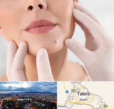 برداشتن خال در تبریز