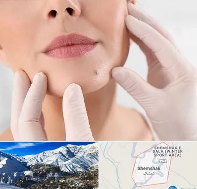 برداشتن خال در شمشک