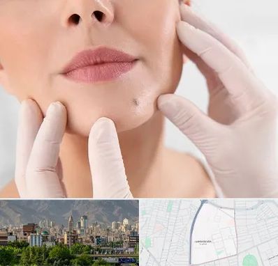 برداشتن خال در جمشیدیه