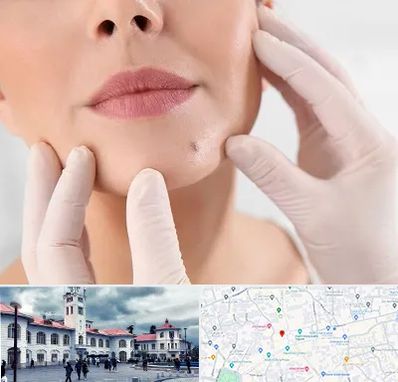 برداشتن خال در میدان شهرداری رشت