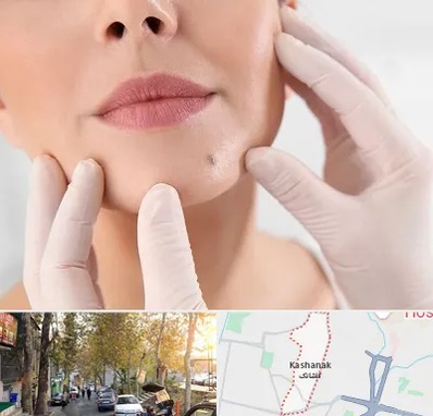برداشتن خال در کاشانک