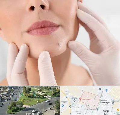 برداشتن خال در شاهین ویلا کرج