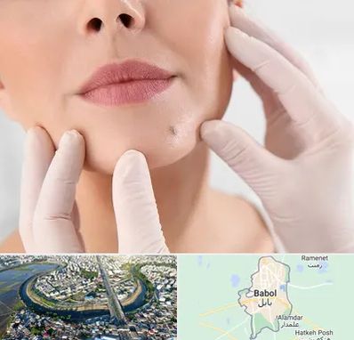 برداشتن خال در بابل