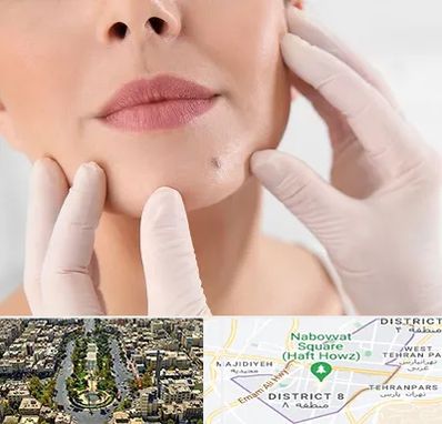 برداشتن خال در نارمک 