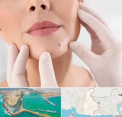 برداشتن خال در سیستان و بلوچستان
