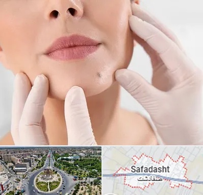 برداشتن خال در صفادشت