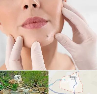 برداشتن خال در کردان