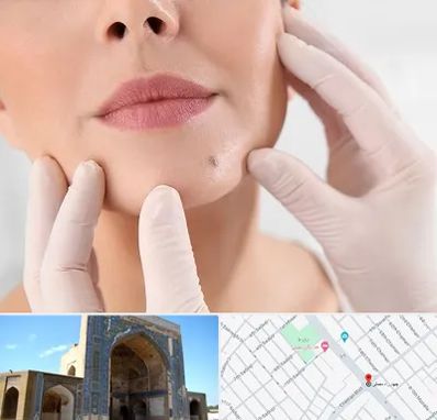 برداشتن خال در مصلی مشهد