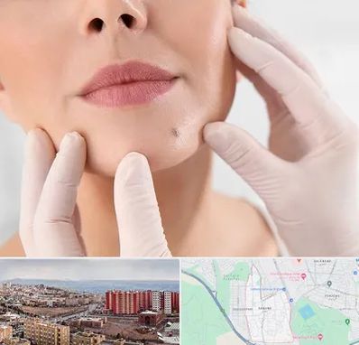 برداشتن خال در سهند تبریز