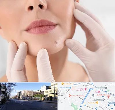 برداشتن خال در خیابان ملاصدرا شیراز