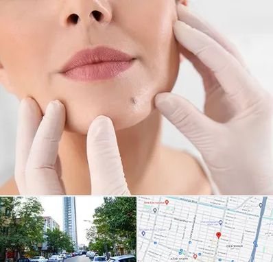 برداشتن خال در امامت مشهد