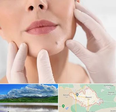 برداشتن خال در مرند