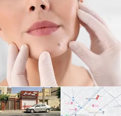 برداشتن خال در باجک قم