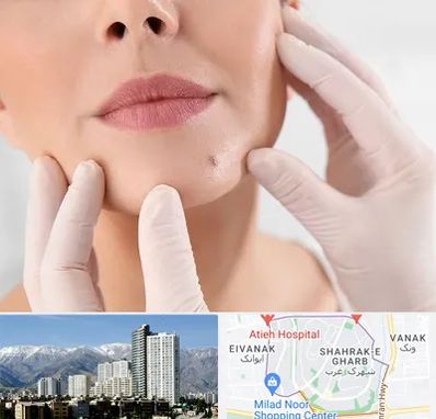 برداشتن خال در شهرک غرب 