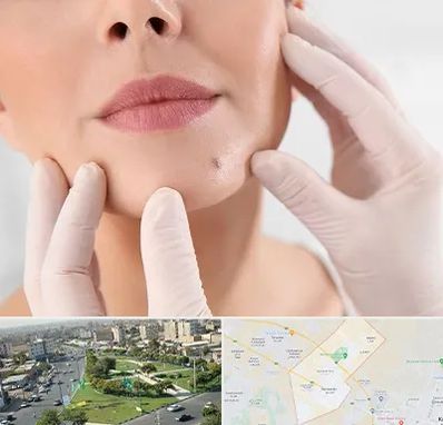 برداشتن خال در کمال شهر کرج