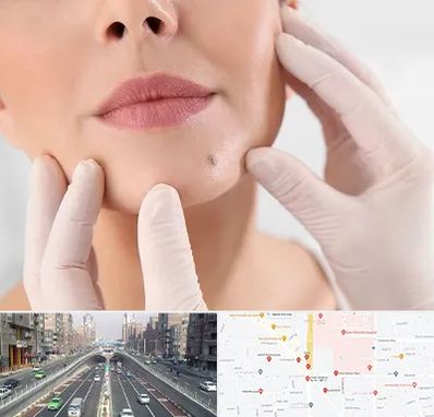 برداشتن خال در توحید