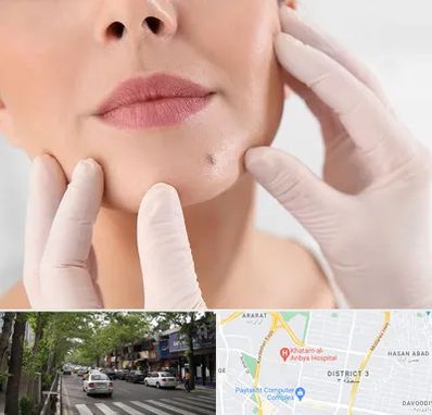 برداشتن خال در ظفر 